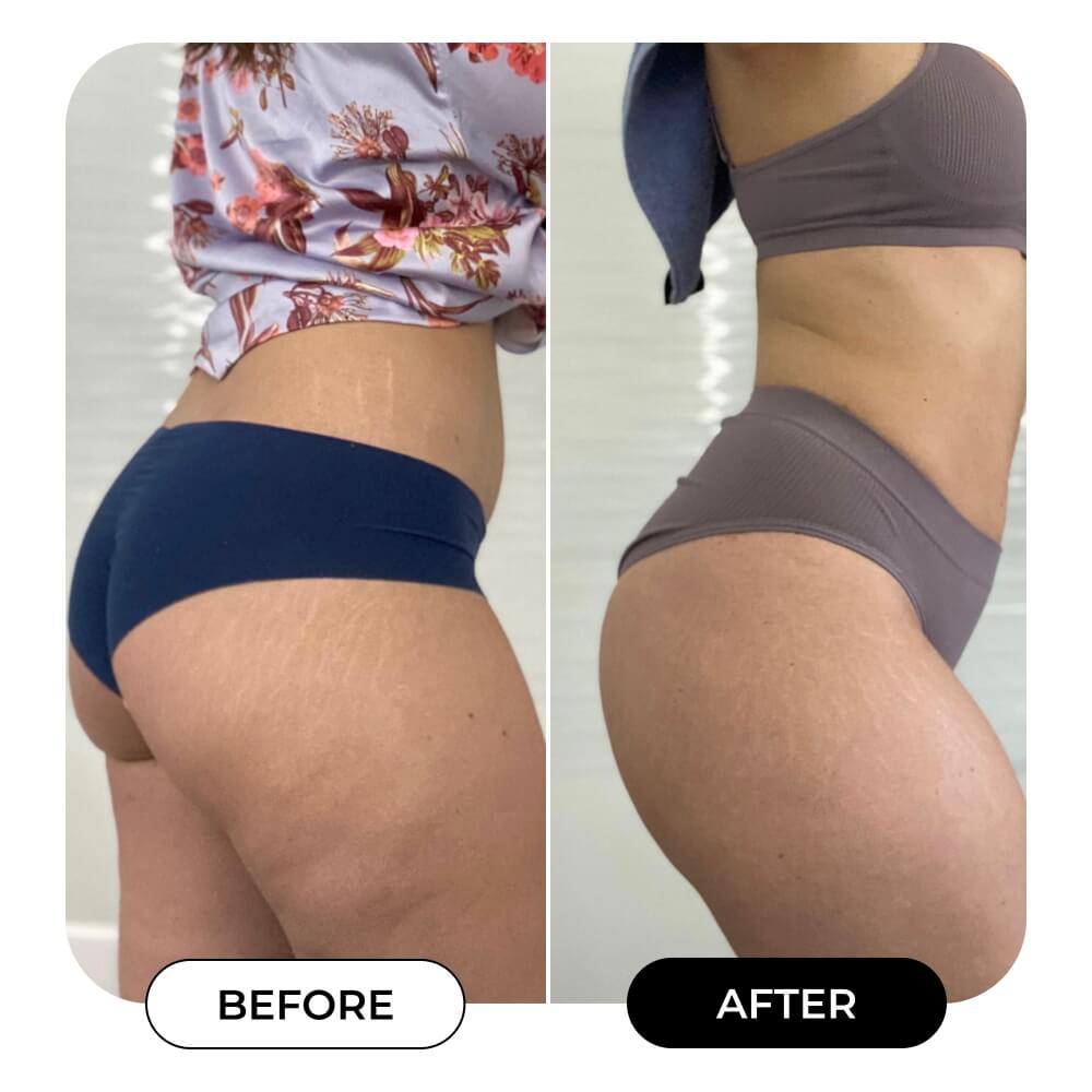 GET-SPRUNG Enriched Oil for Stretch Marks | MAЁLYS®