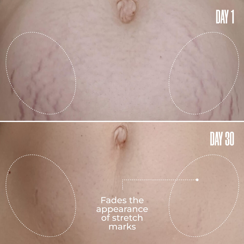 GET FLATTERED The Loose Skin Duo | MAЁLYS®