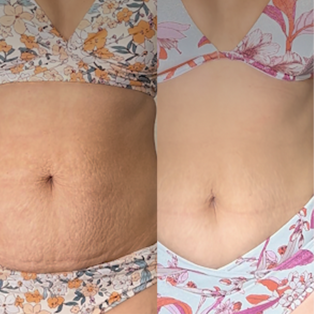 Before and after GET-TAUT on the belly